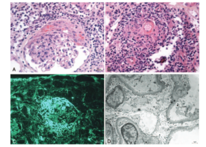 Glomerulonepritis